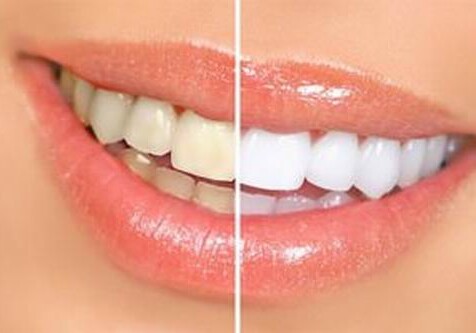 Новая технология поможет восстановить эмаль зубов