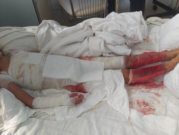 SOS: У 7-летней Ягмур обожжено все тело, а денег на операцию нет (Фото)