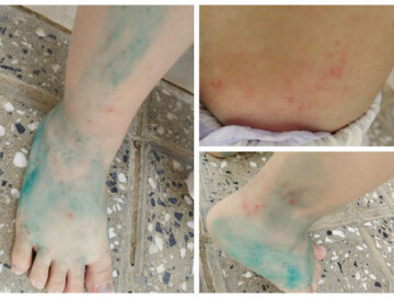 TƏBİB сделало заявление в связи с кожным заболеванием среди воспитанников детского приюта